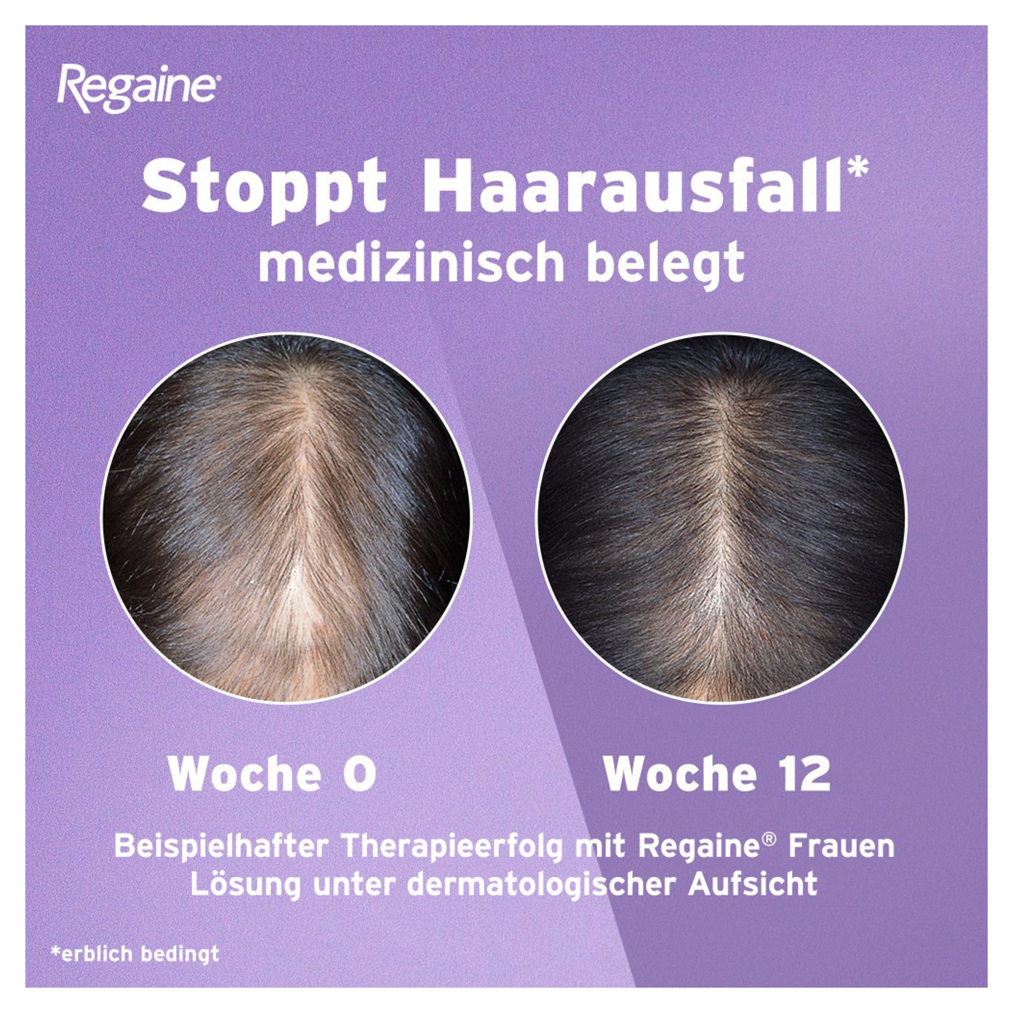 Erfahrungen zu Regaine Frauen Seite 3 medpex